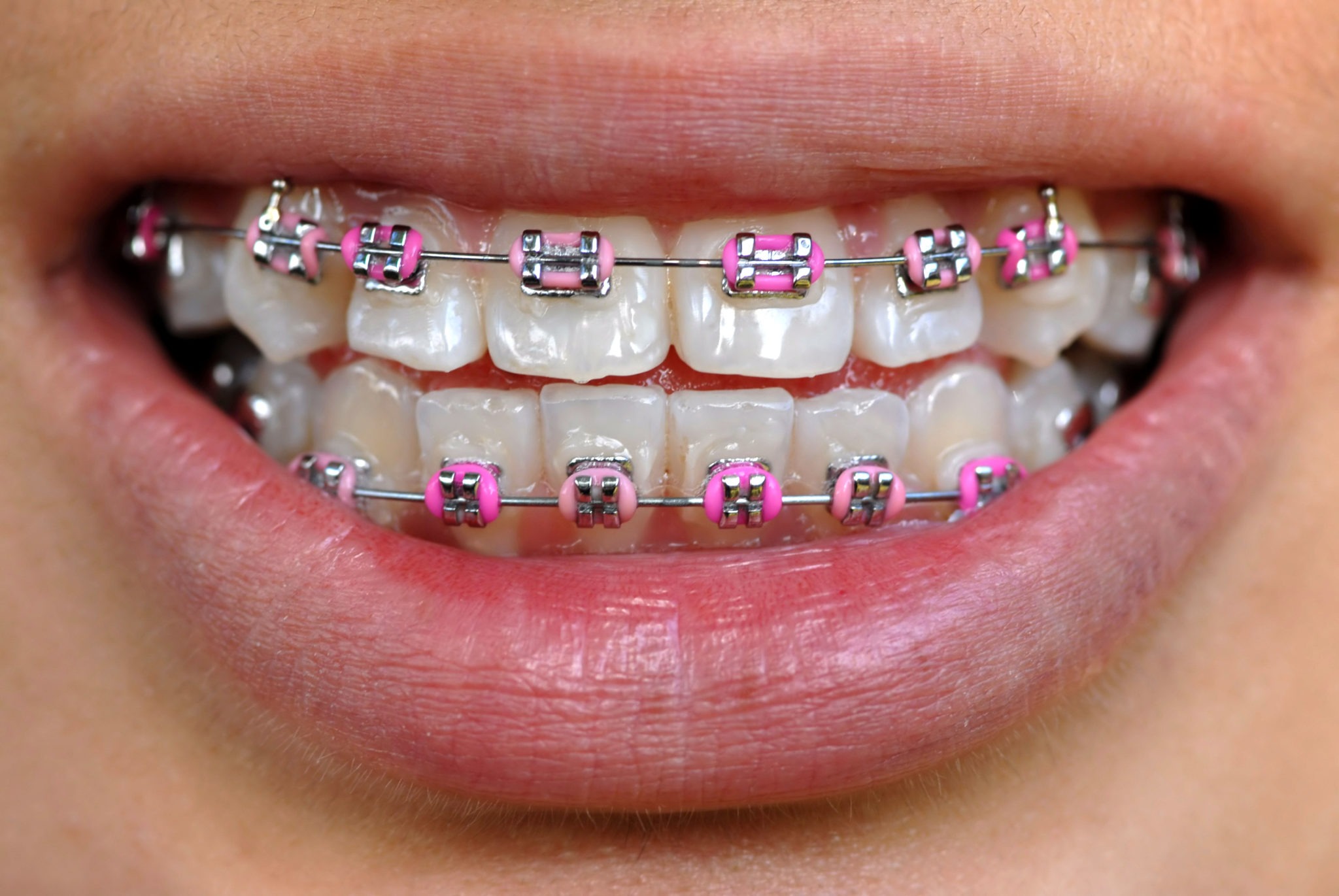 How To Choose Colors For Braces Nutley Braces Ollins Orthodontics