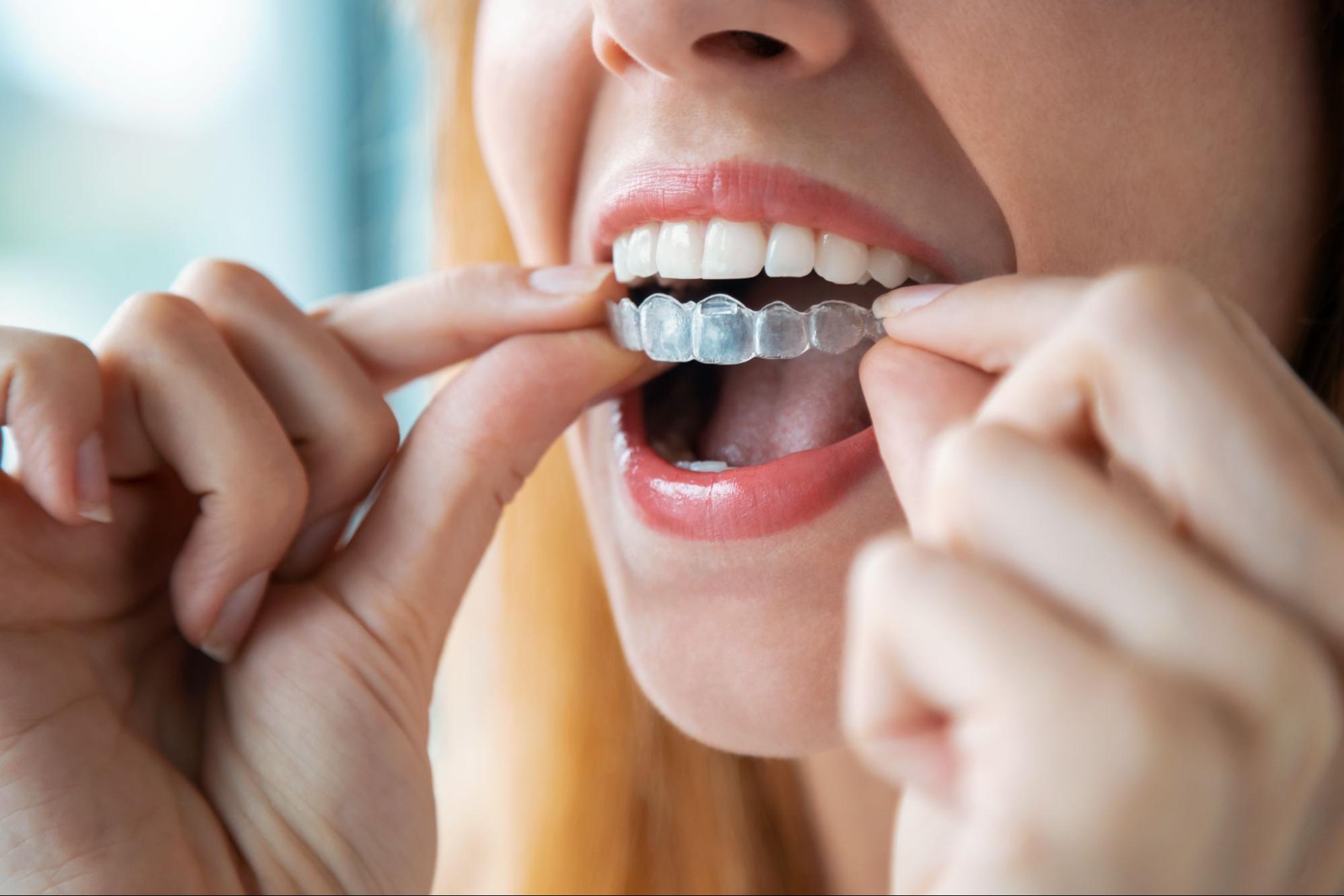 The Benefits of Seeing an Orthodontist In Your Local Community