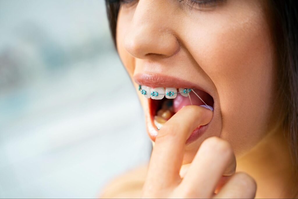 What Is the Role of Rubber Bands in Braces Treatment?