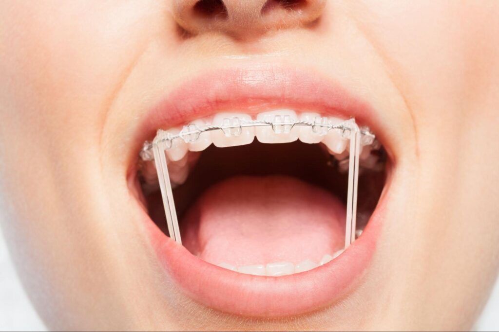 What Is the Role of Rubber Bands in Braces Treatment?