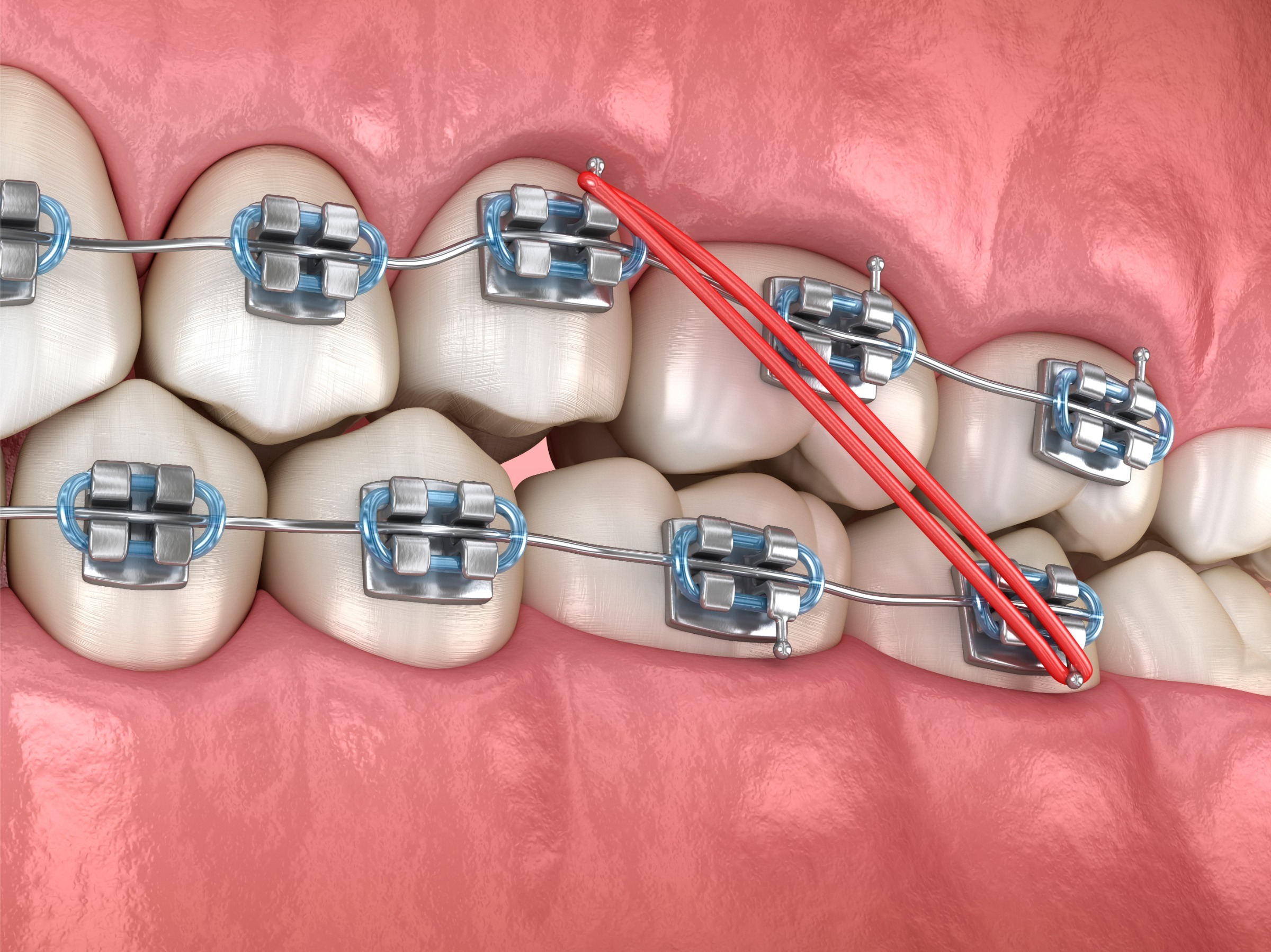 braces passaic